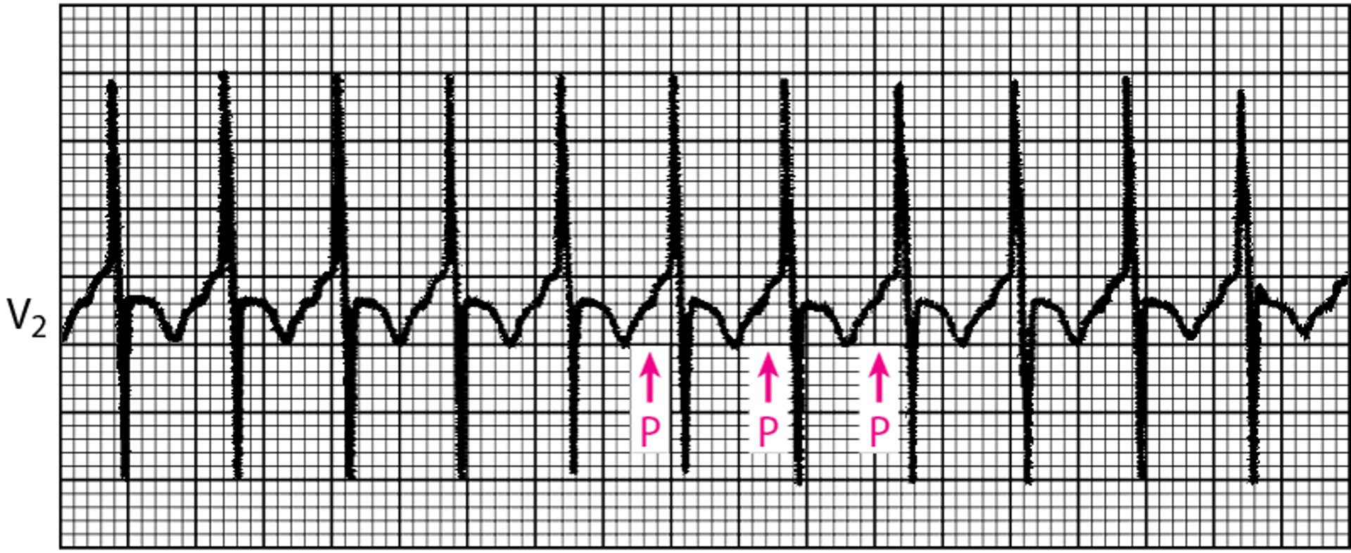 Tachycardie auriculaire focale