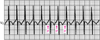 真の心房頻拍（true atrial tachycardia）