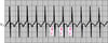 Taquicardia atrial focal