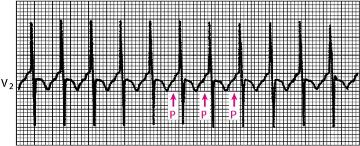 Taquicardia atrial focal