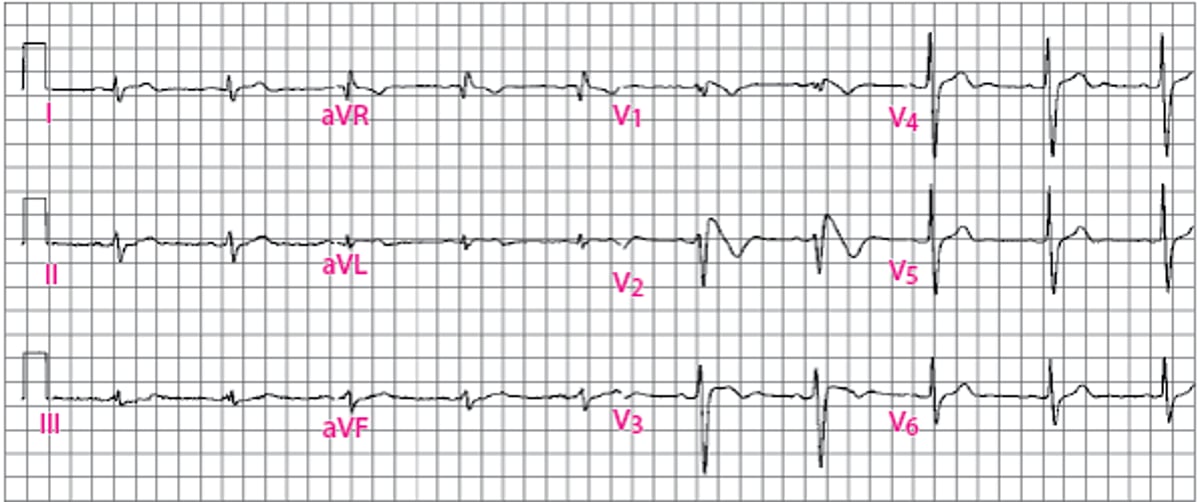Type 1 Brugada ECG Pattern