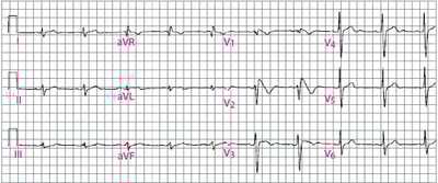 Type 1 Brugada ECG Pattern