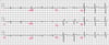 Brugada EKG-Muster Typ 1