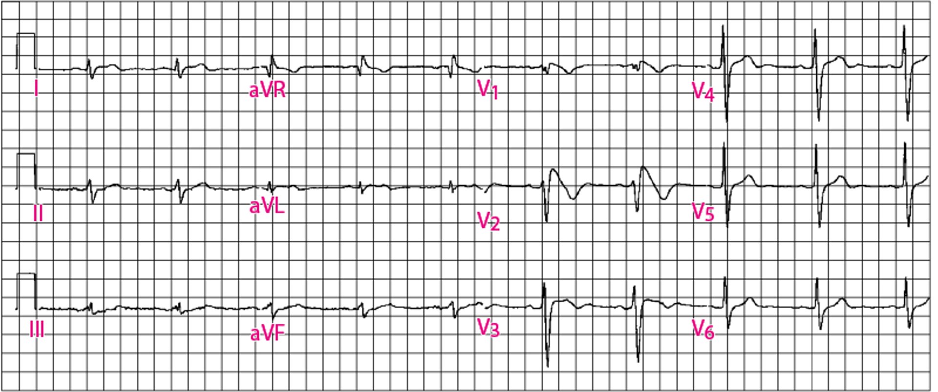 Brugada EKG-Muster Typ 1