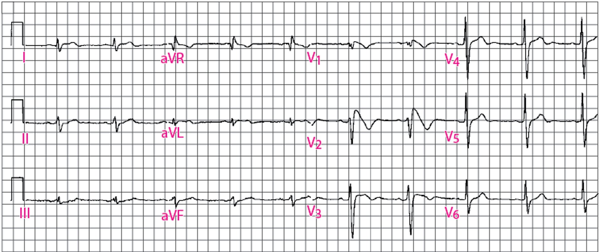 Patrón ECG del síndrome de Brugada tipo 1