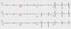 ECG de Brugada de Type 1