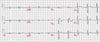 Padrão ECG de Brugada tipo 1