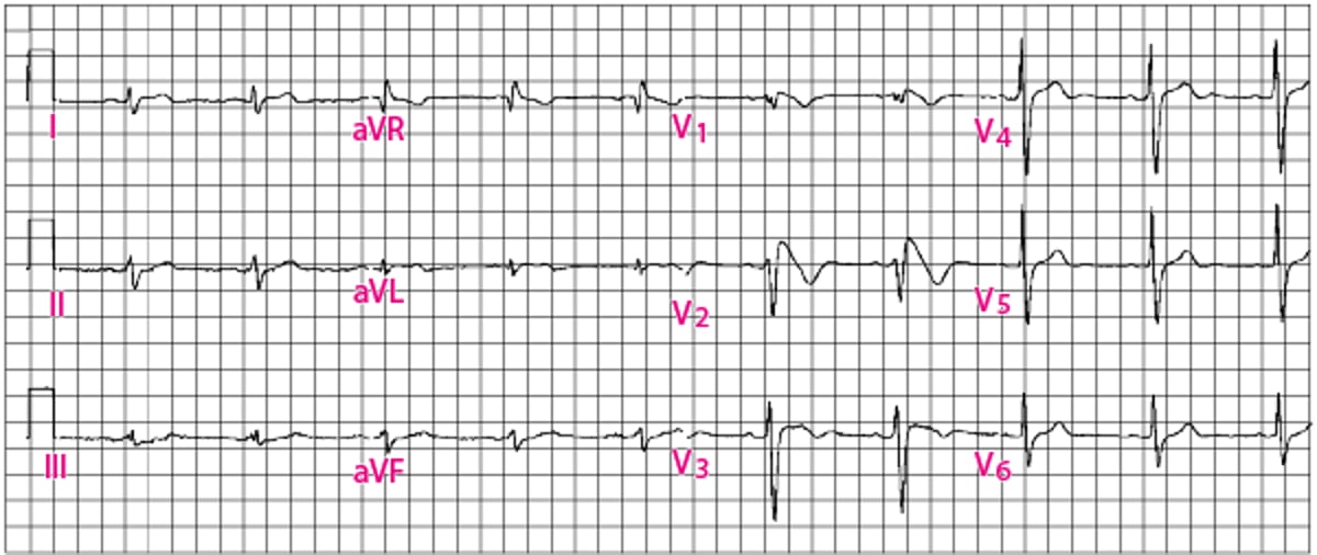Padrão ECG de Brugada tipo 1