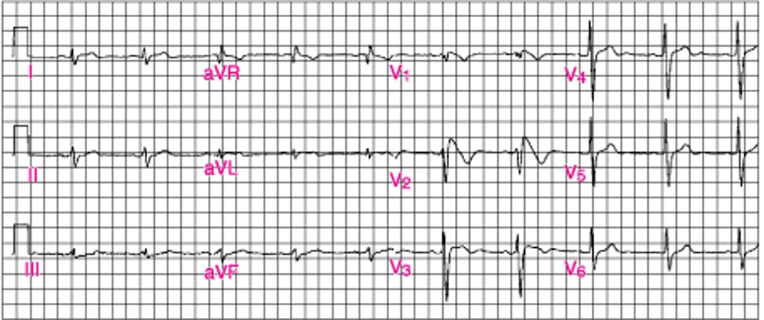 ЭКГ-паттерн типа 1 по Бругада