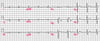 Mẫu ECG Brugada loại 1