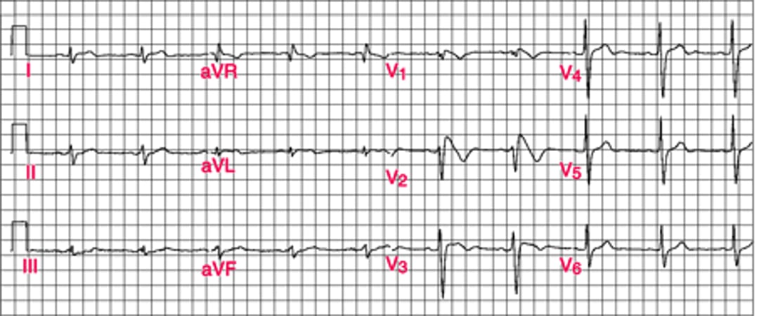 Mẫu ECG Brugada loại 1
