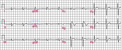 Mẫu ECG Brugada loại 1