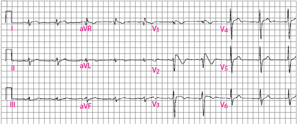 1型Brugada ECG模式