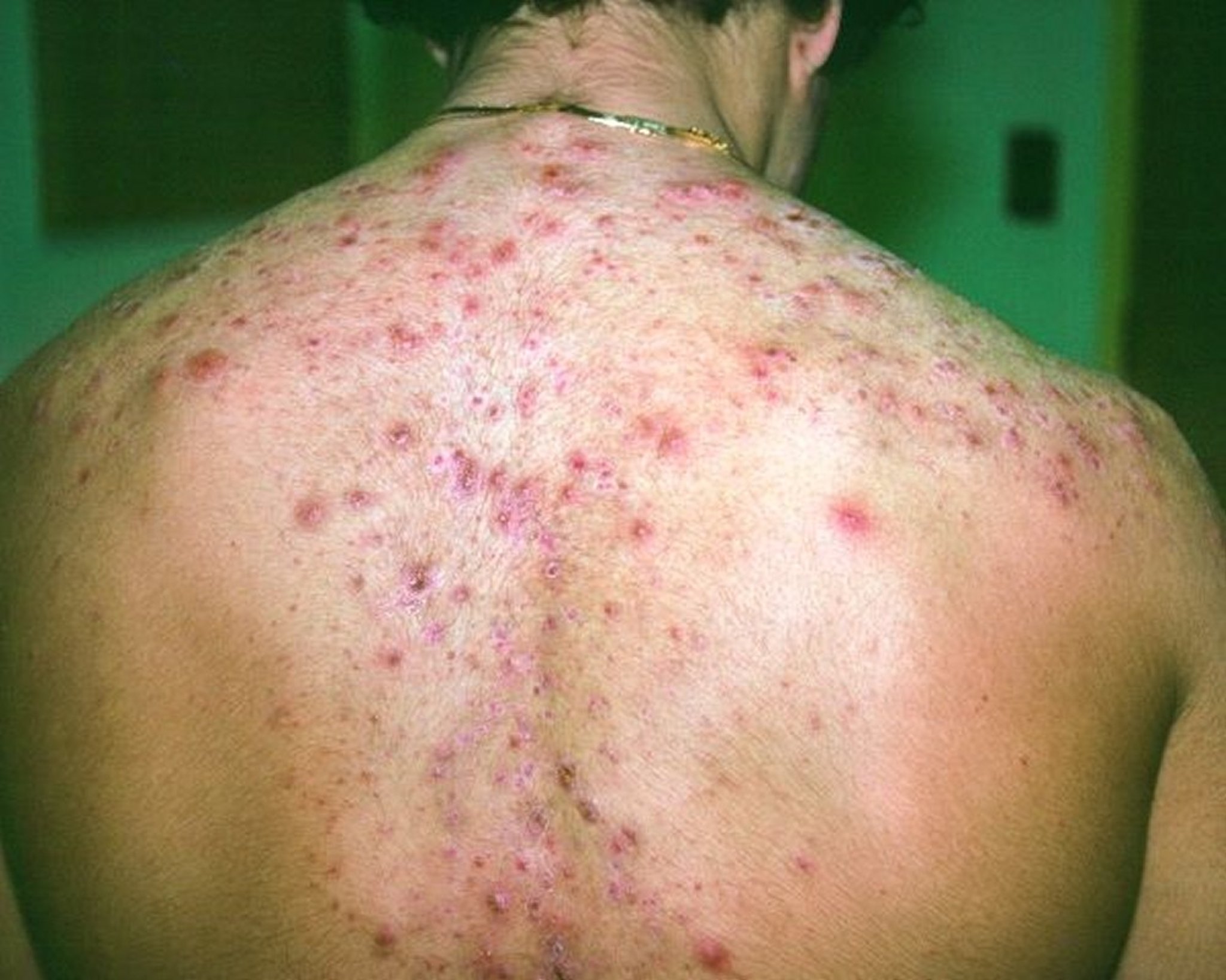 Cystic Acne