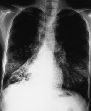 Mukoviszidose (Röntgenaufnahme des Thorax)