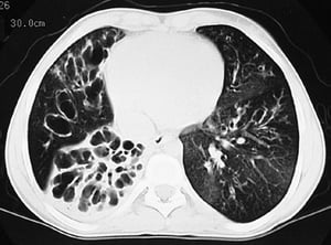 Fibrosis quística (TC)