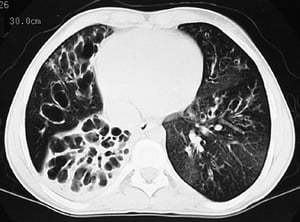 嚢胞性線維症（CT）