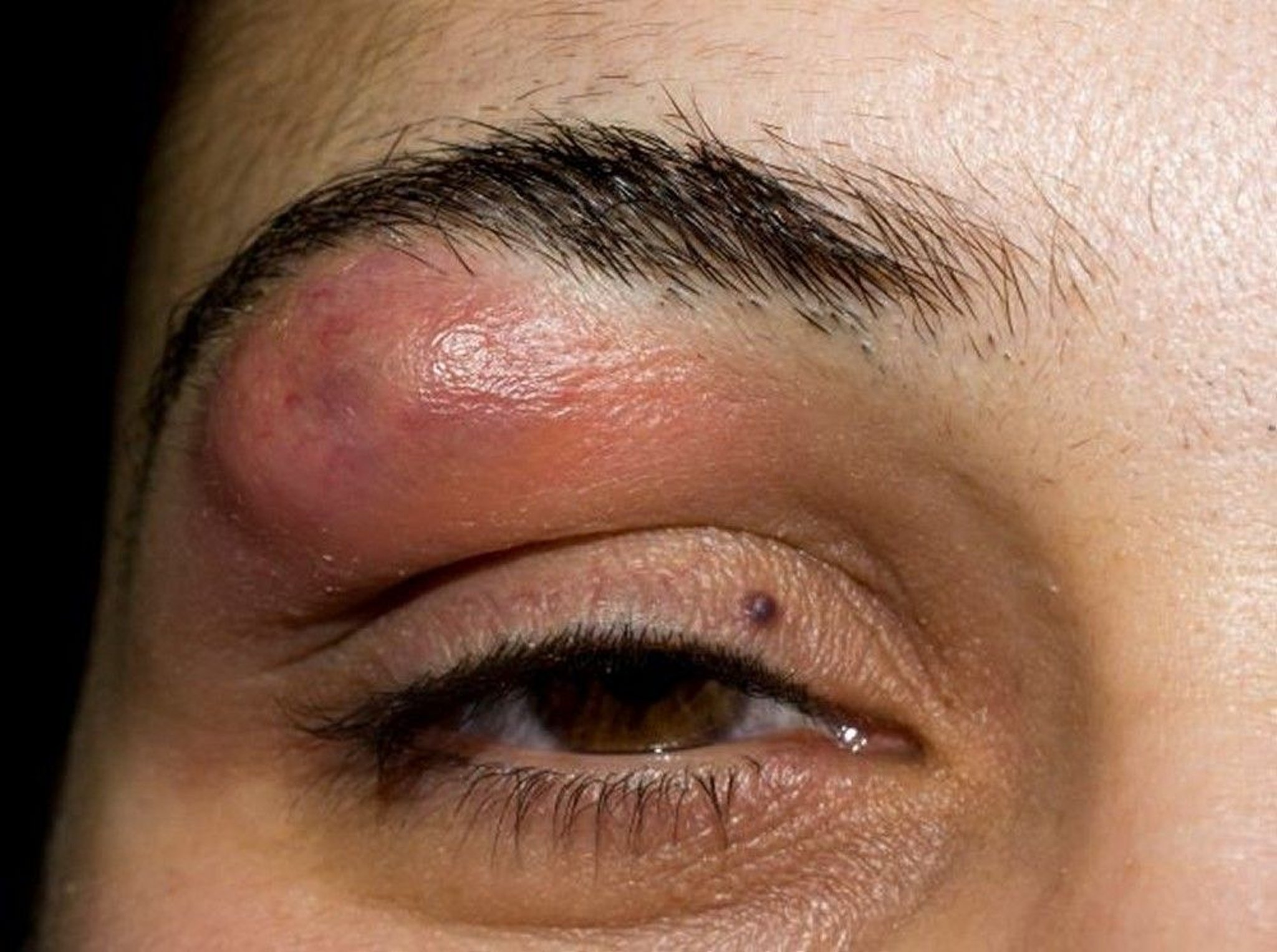 Forúnculo (facial)