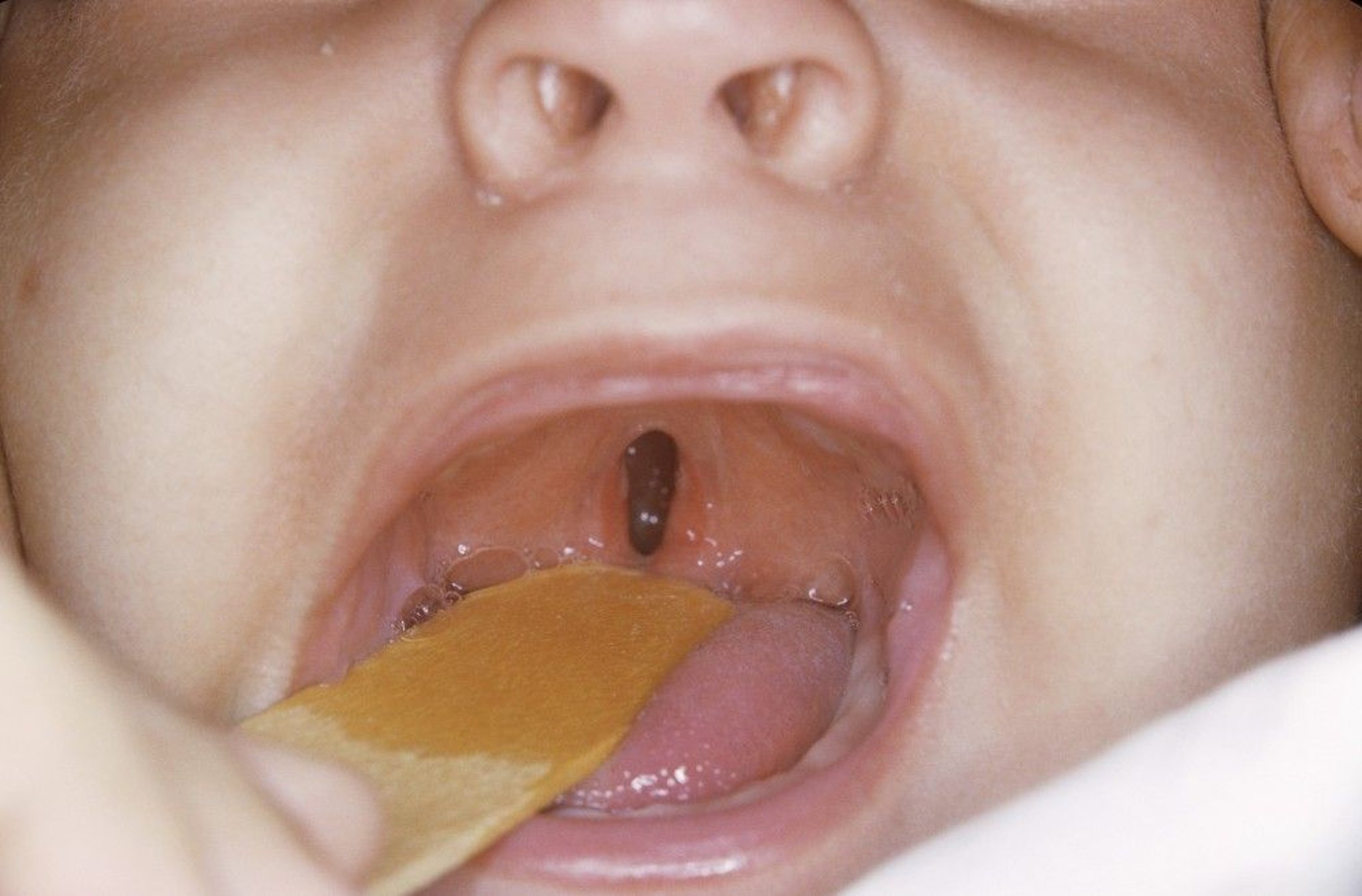 Cleft Palate