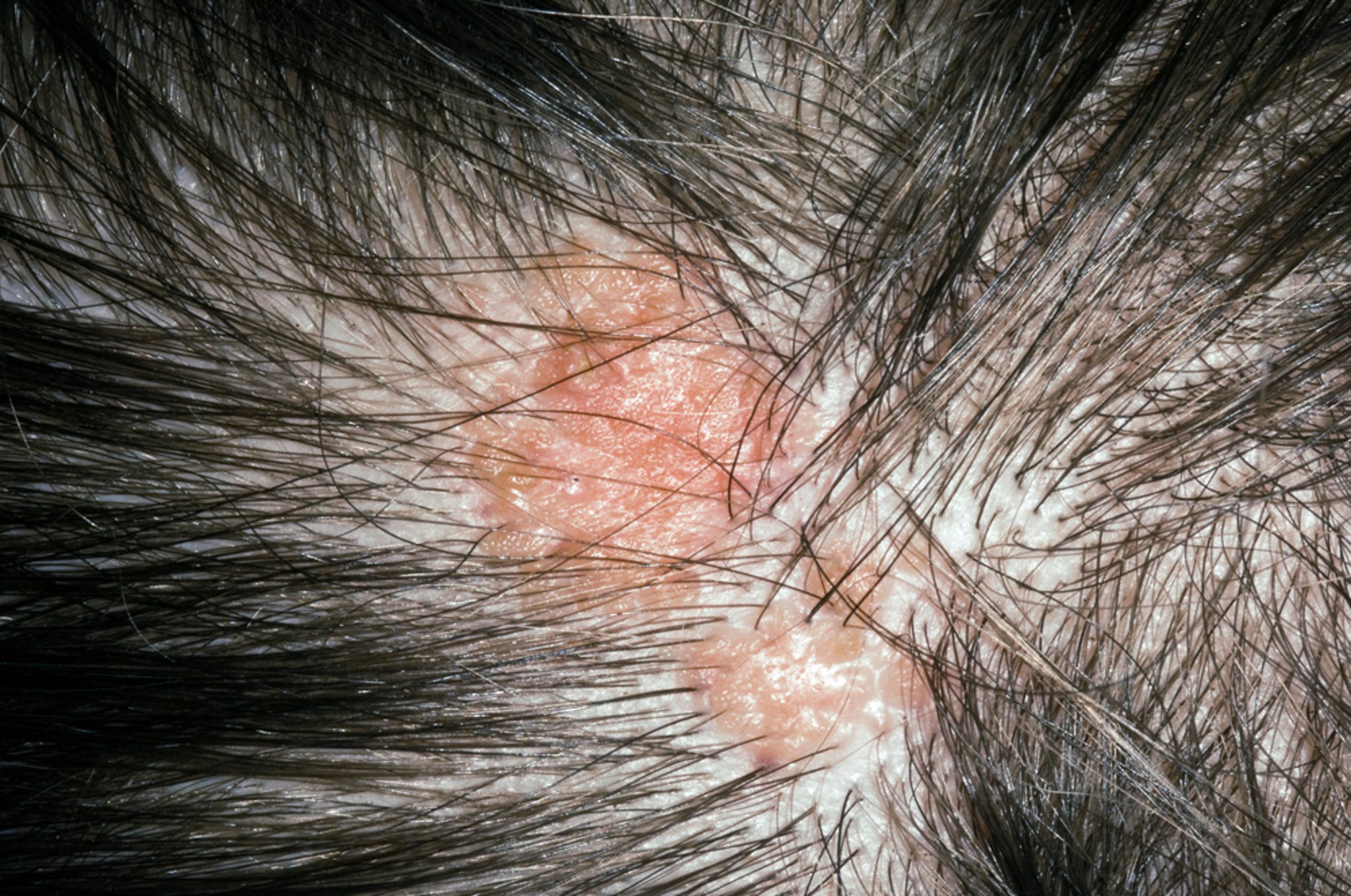 Nevus Sebaceus