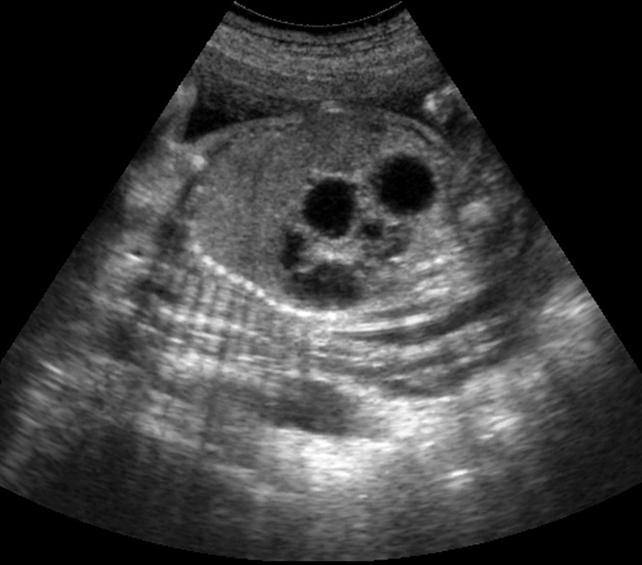 Double-Bubble Effect (Ultrasound)