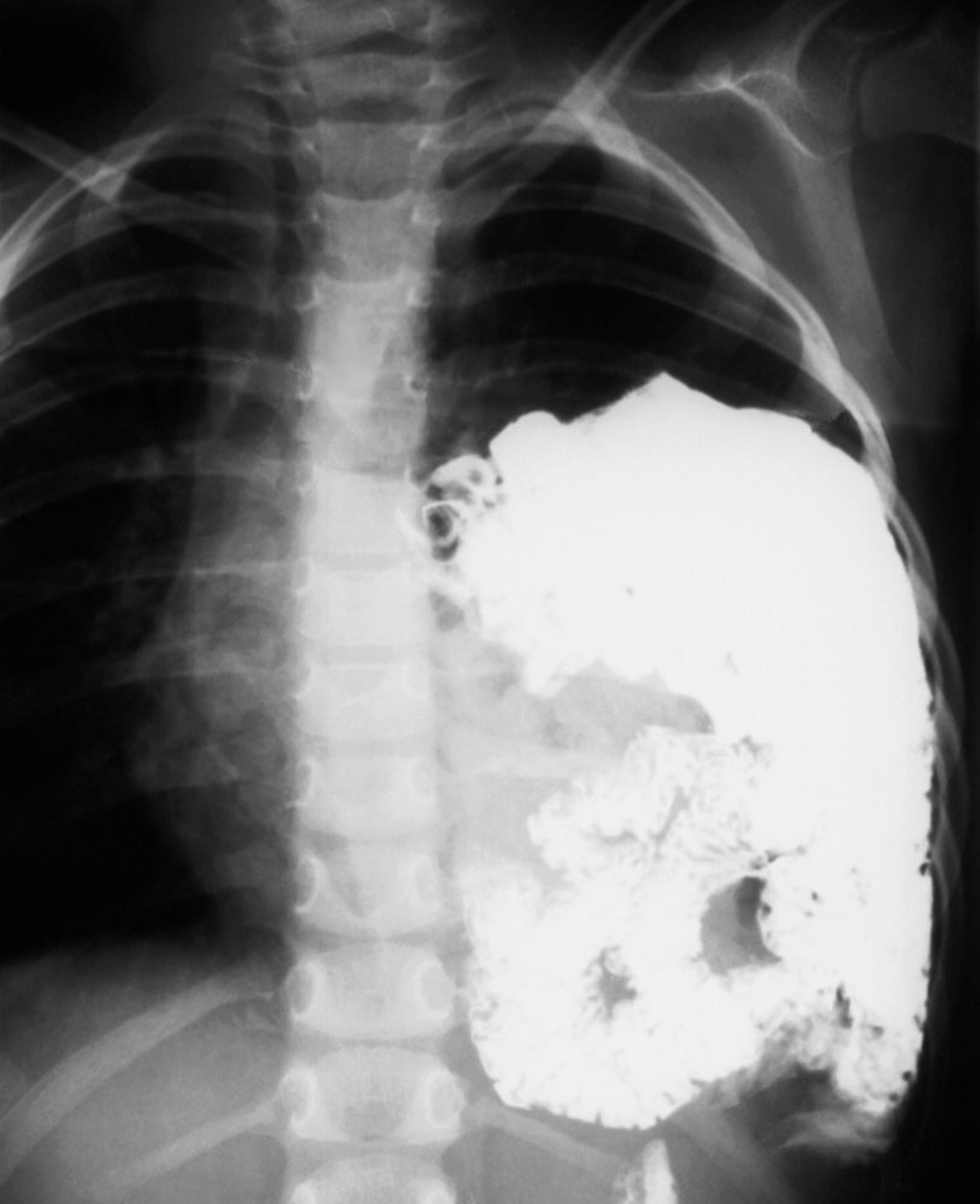 Diaphragmatic Hernia (2)