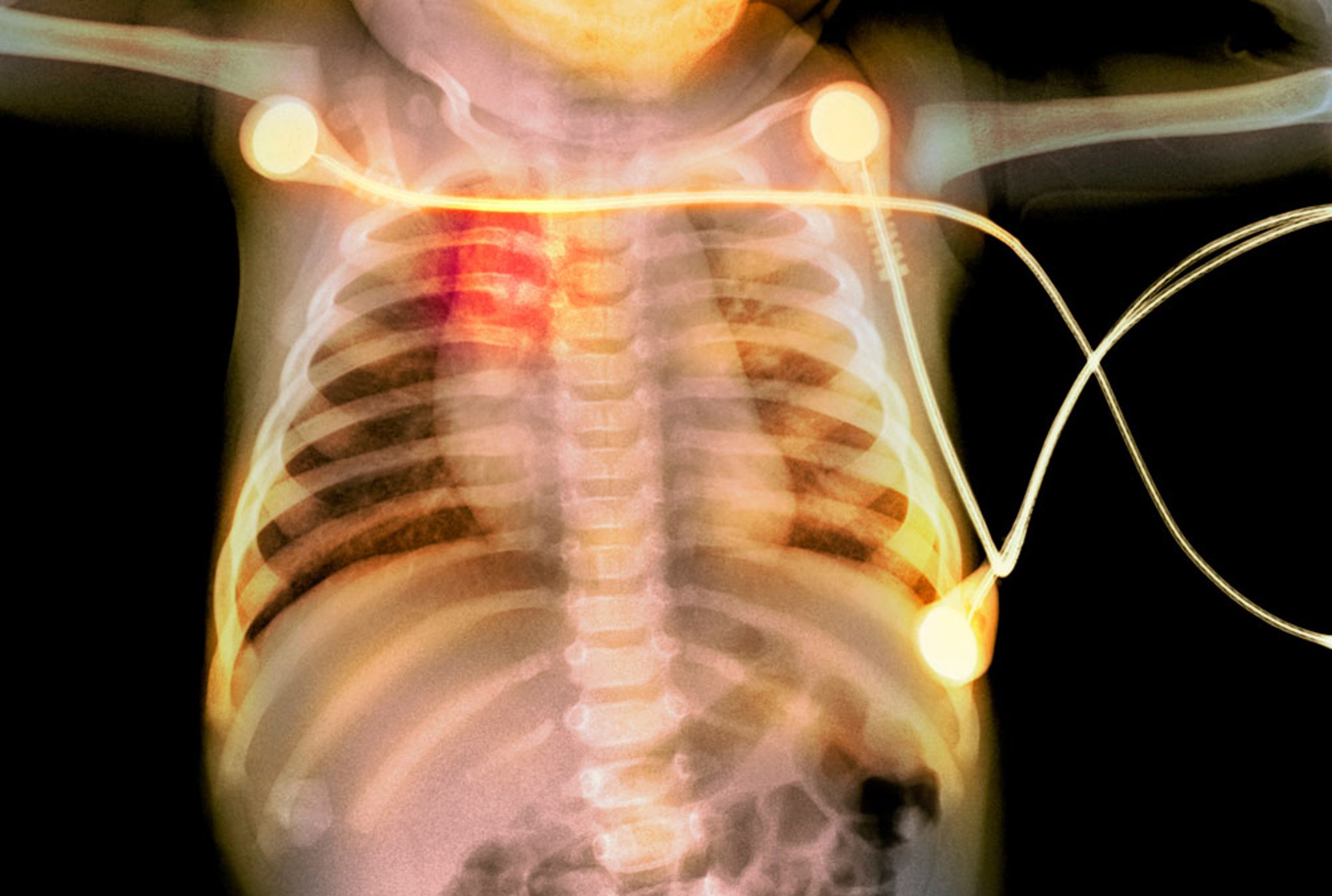 Rib Fractures in an Infant