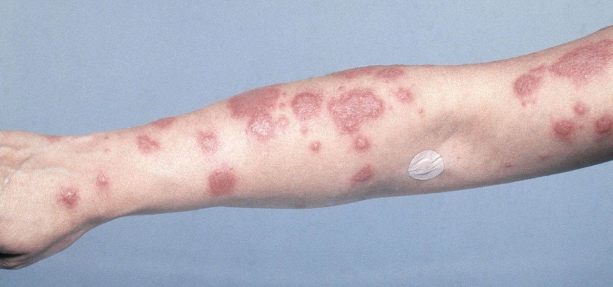 Acute Febrile Neutrophilic Dermatosis (Sweet Syndrome) (2)