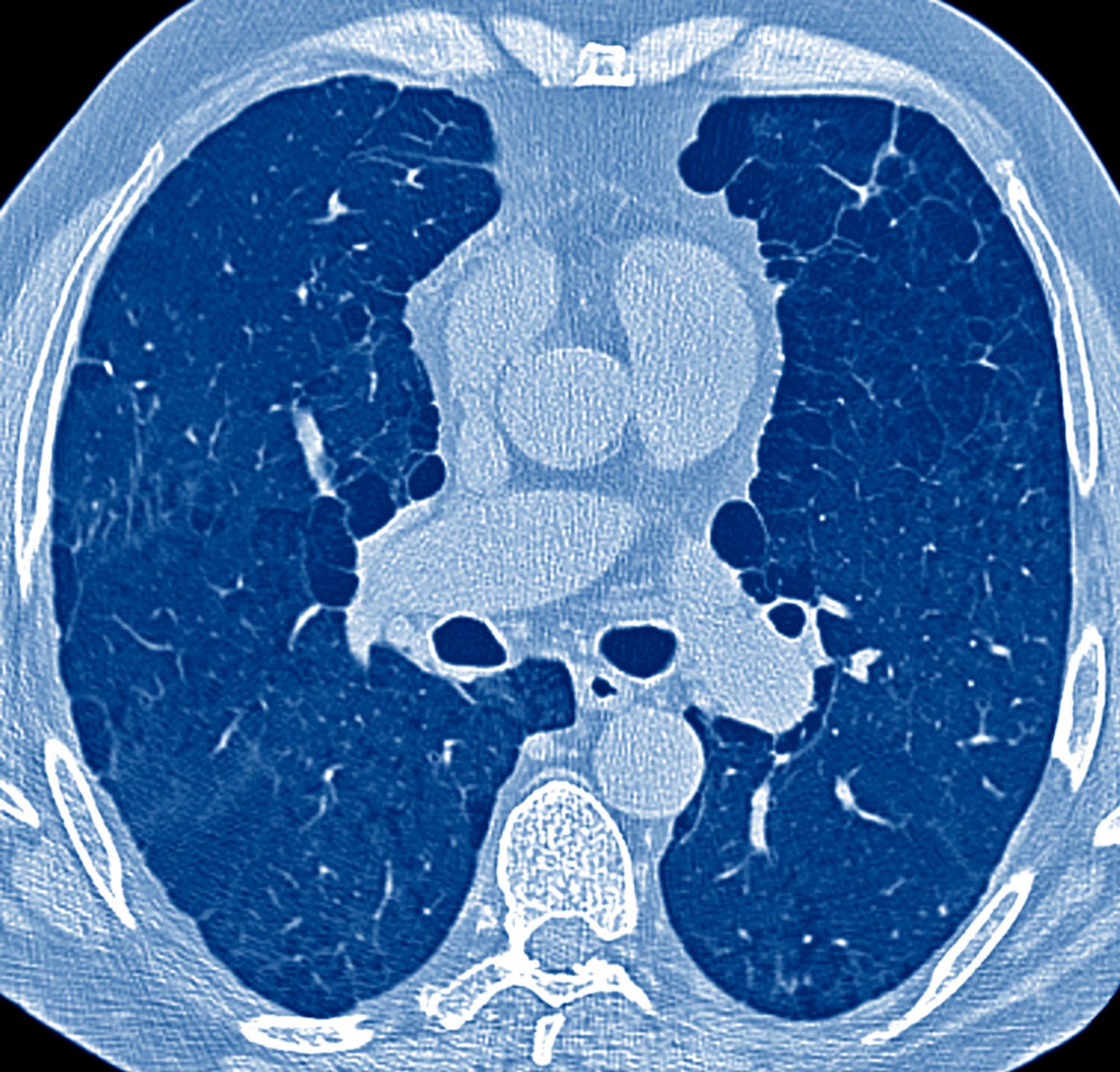 Increased Anterior-Posterior (AP) Diameter in Emphysema