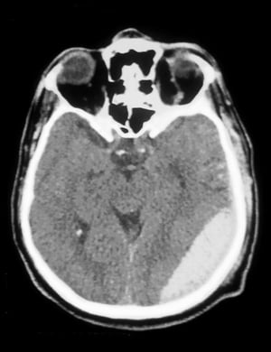 Epiduralhämatom