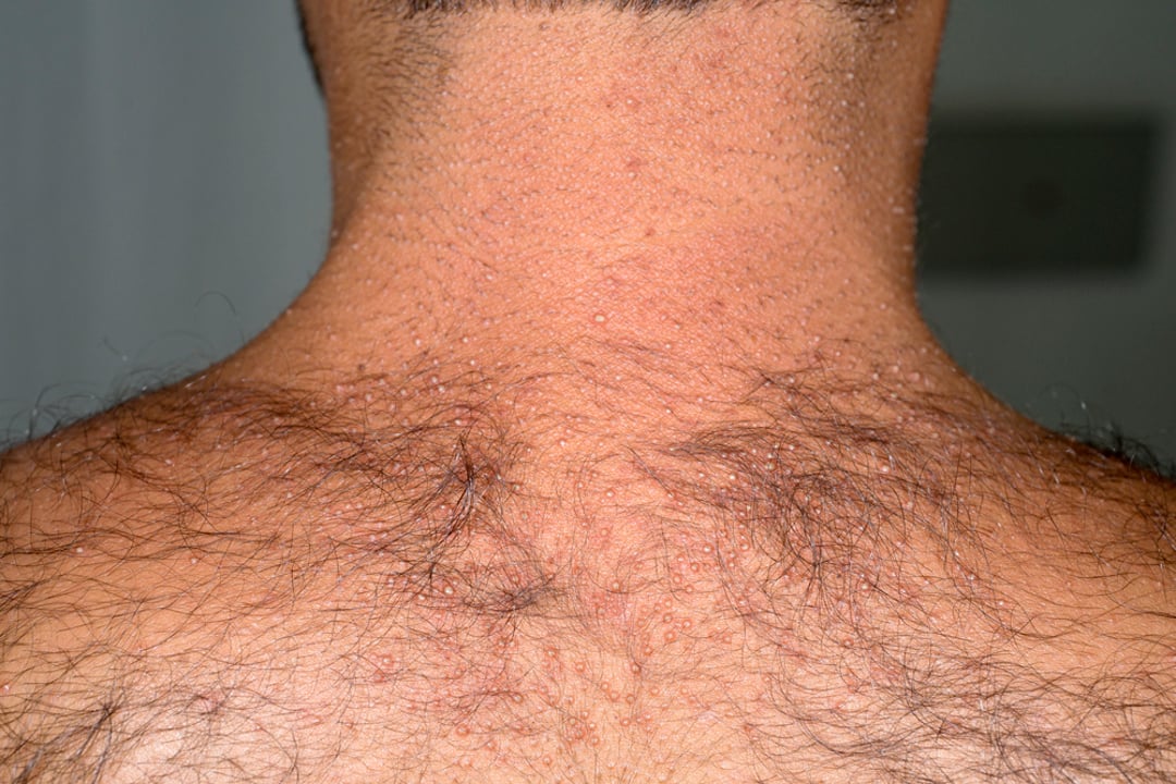 Miliaria Miliaria MSD Manual Professional Edition