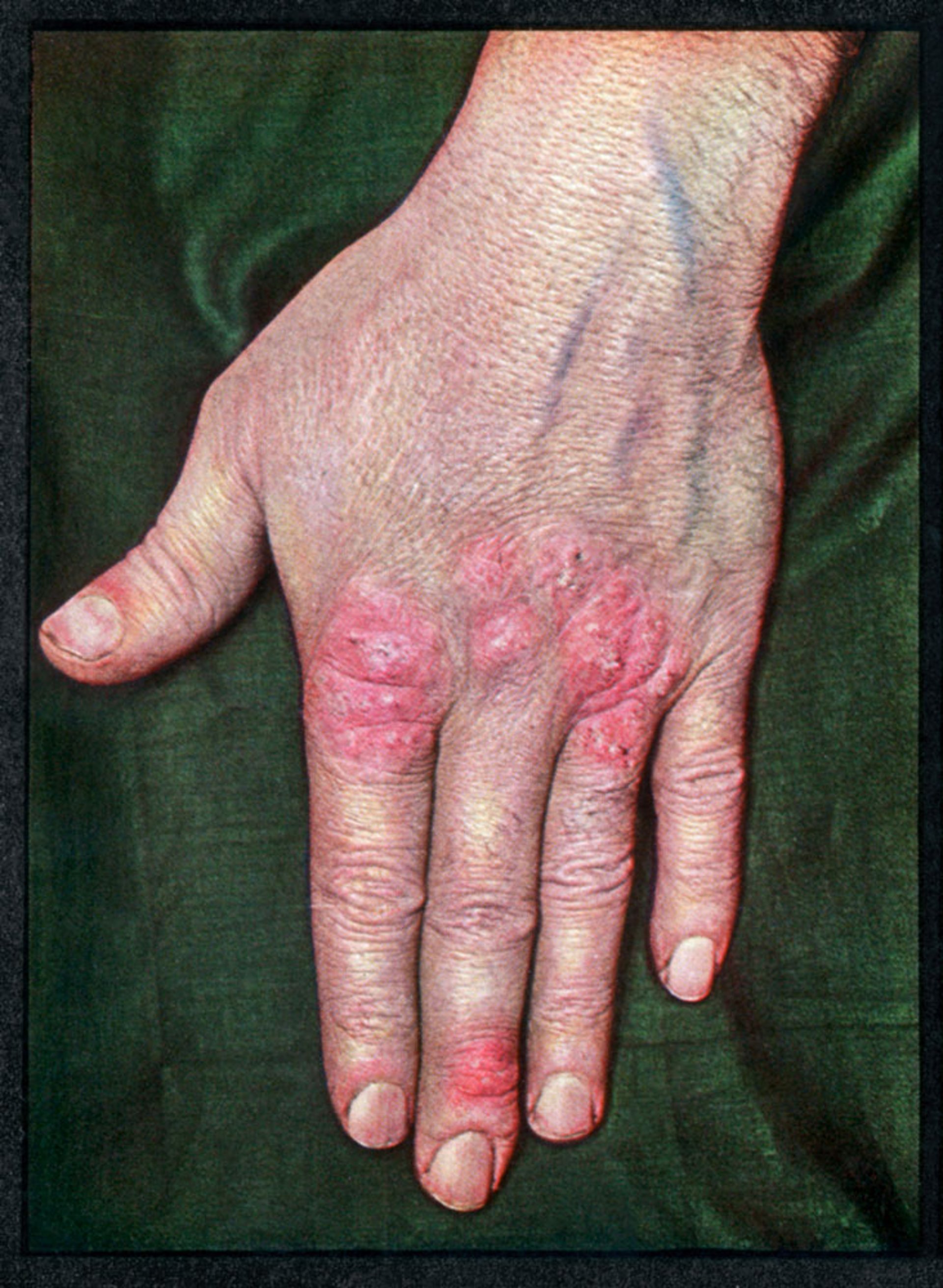 Tubercolosi verrucosa cutis