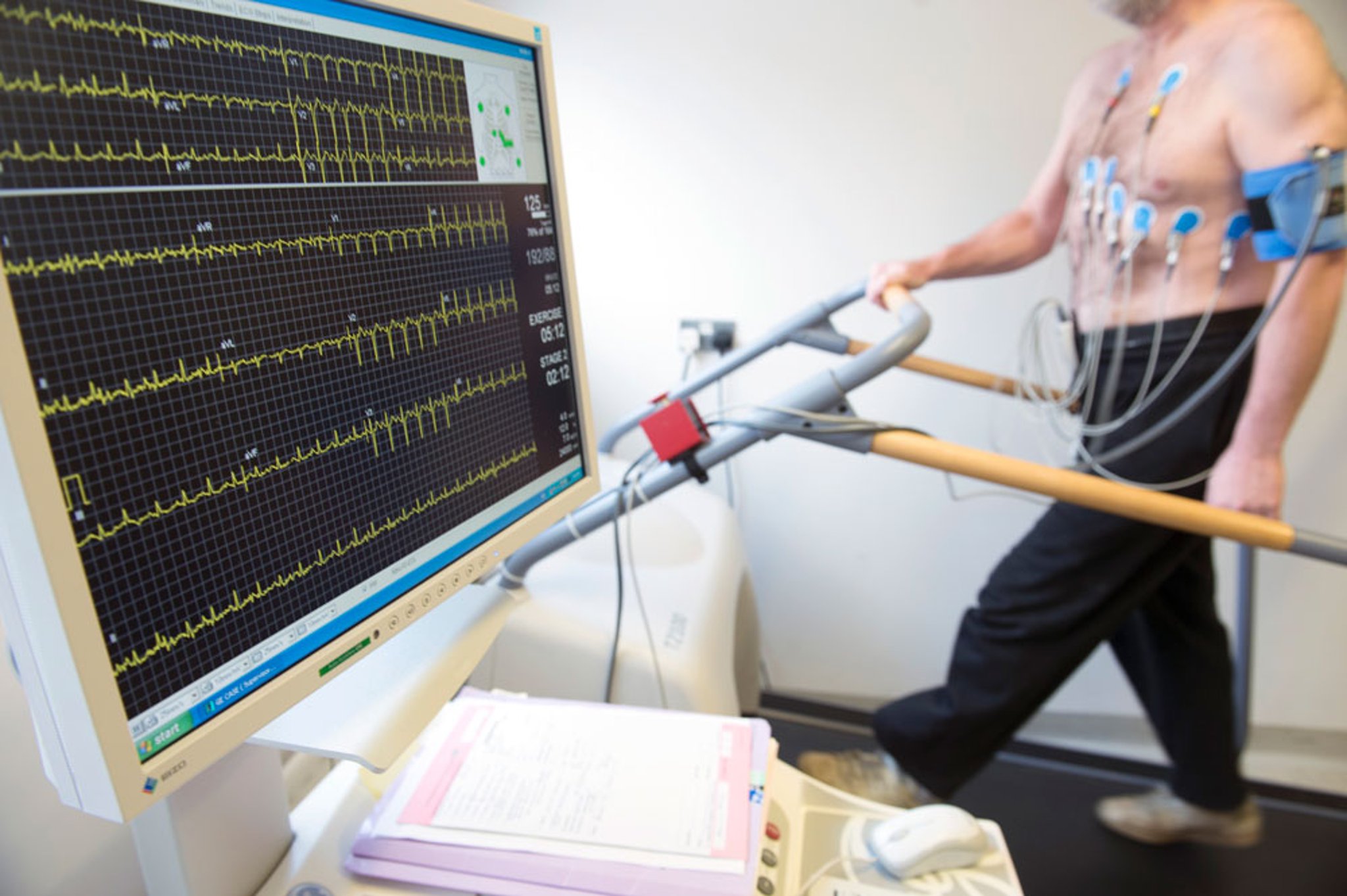Stress Test (Exercise Electrocardiogram [ECG])