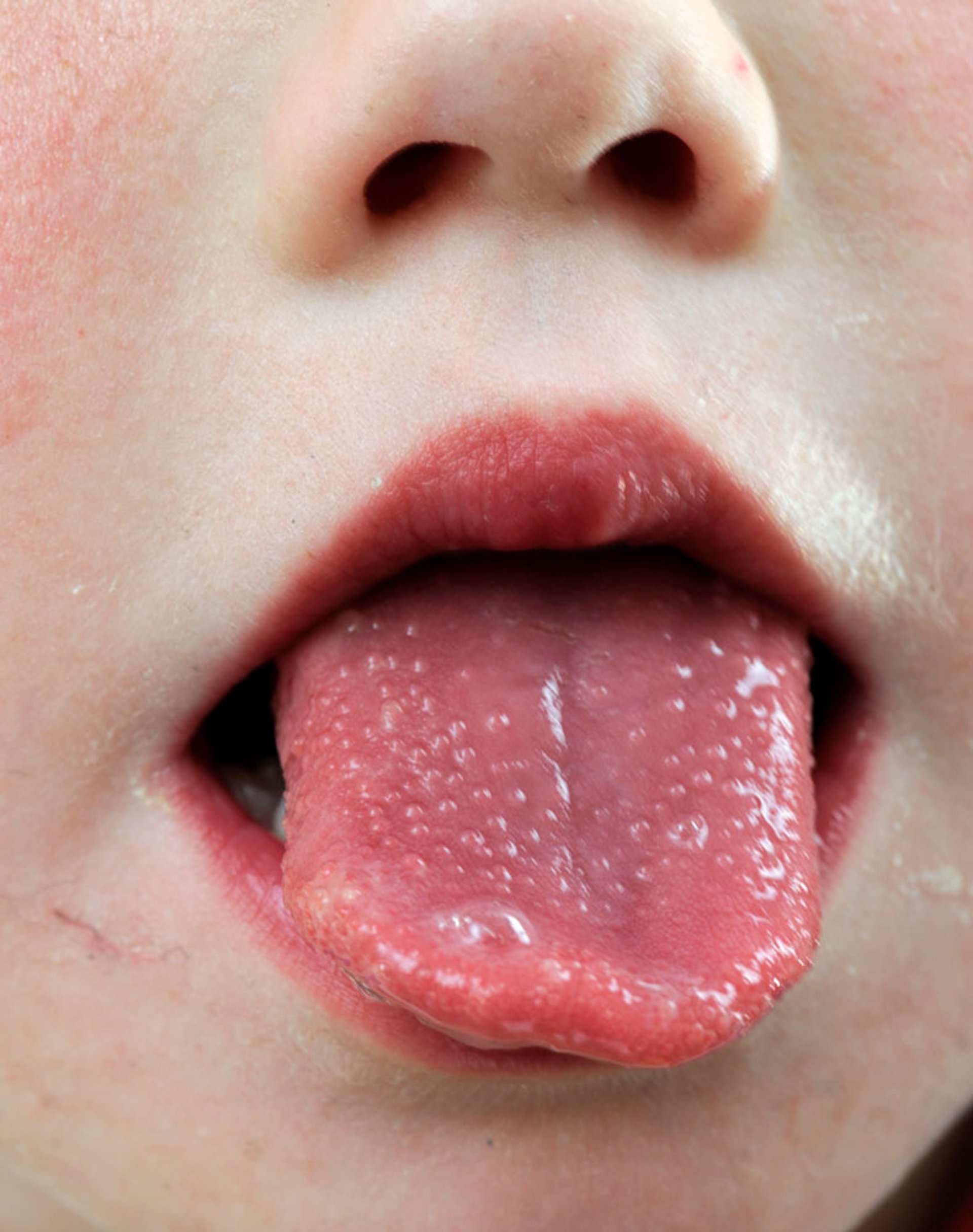Langue fraise ou framboisée (enfant)