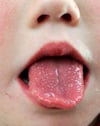 Lưỡi dâu (trẻ em)