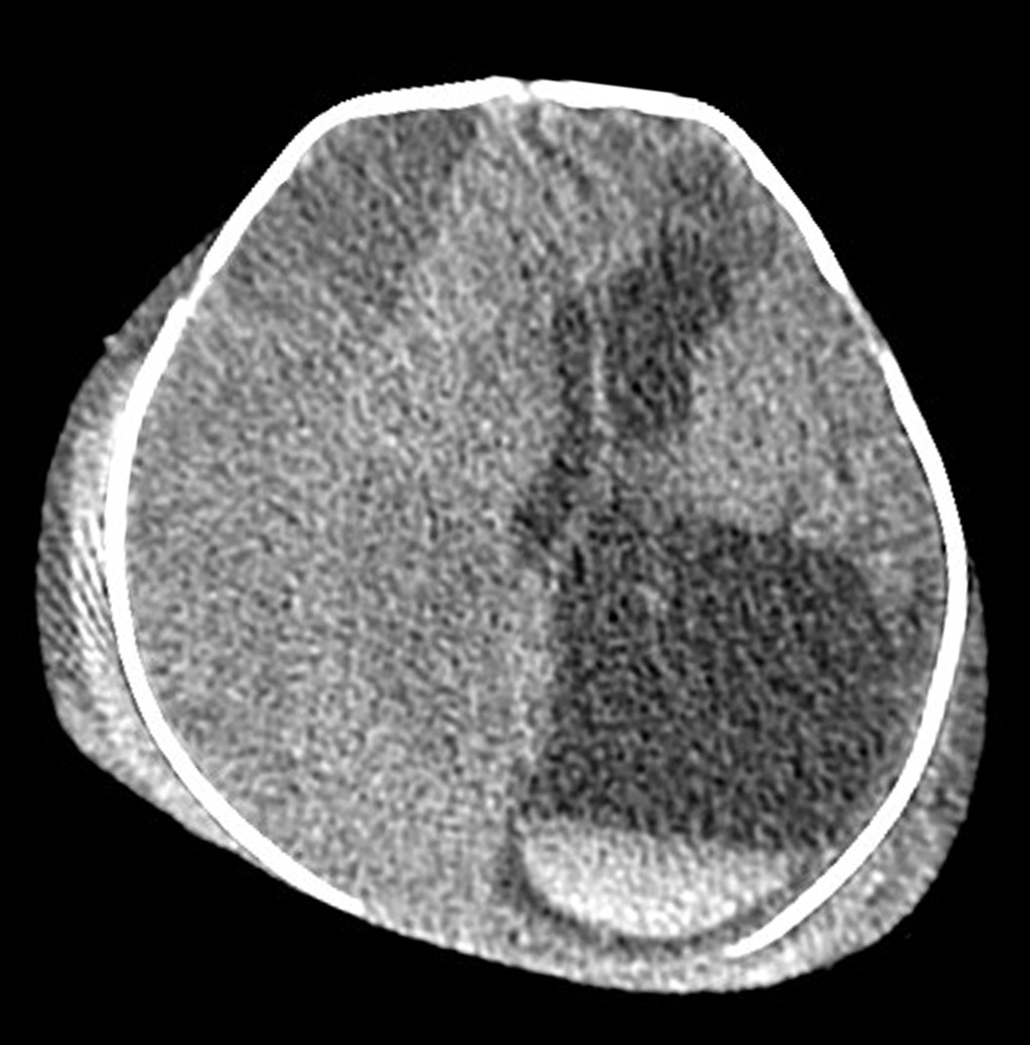 Extensive Birth Injuries in a Neonate (CT Scan)