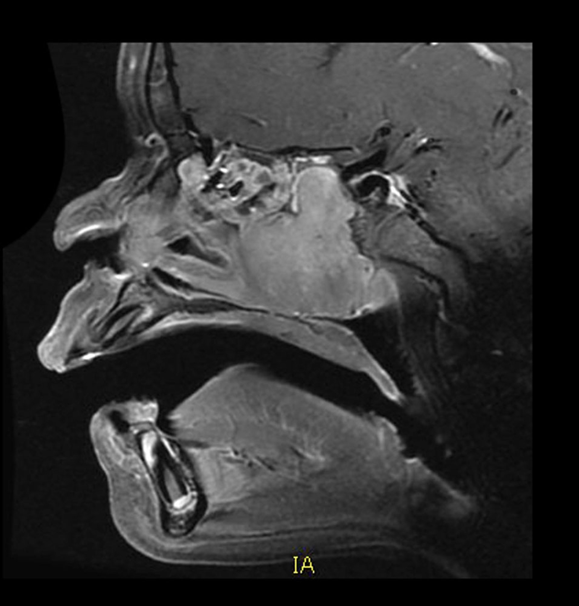 Juvenile Nasopharyngeal Angiofibroma (MRI)