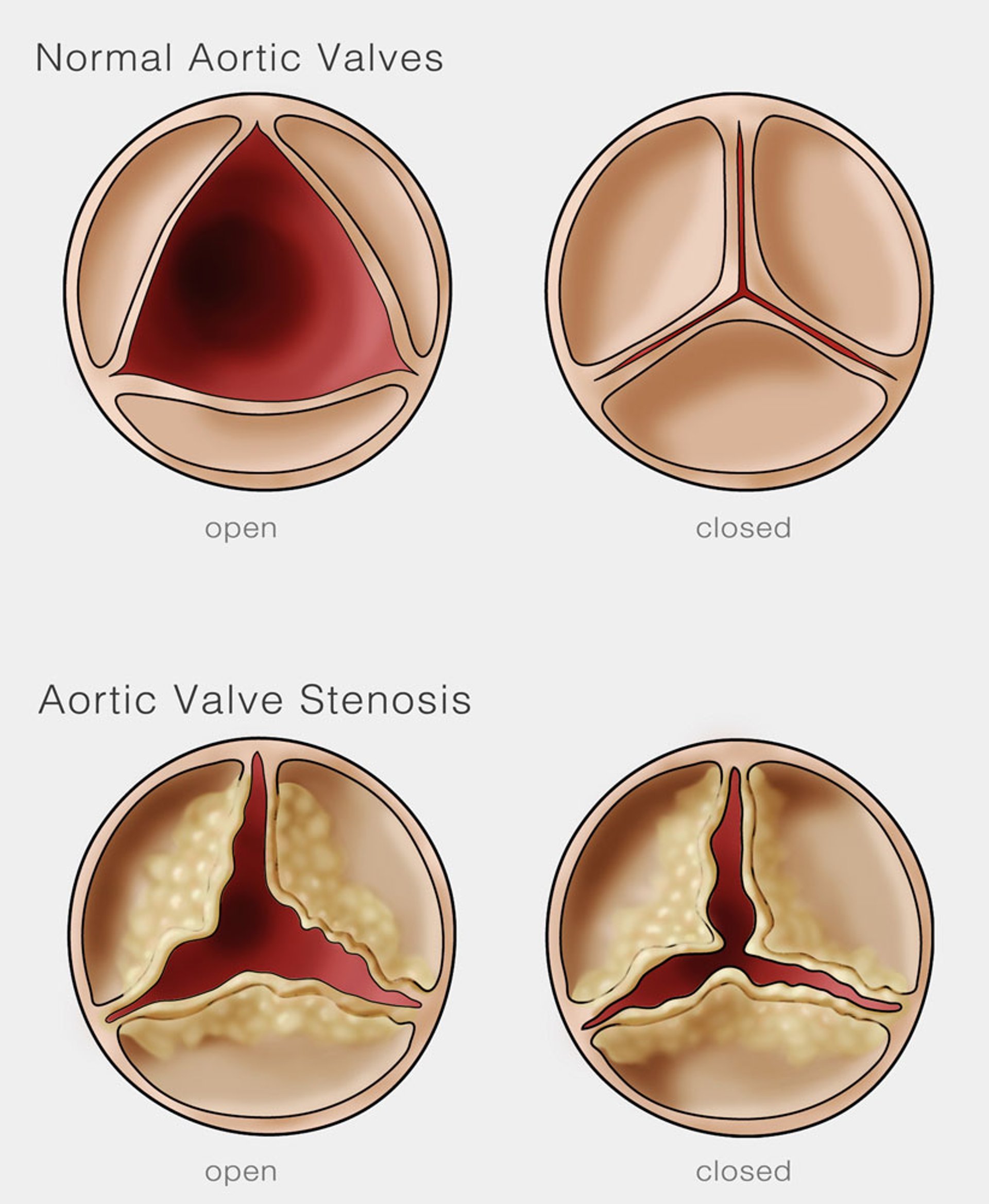 Estenosis aórtica