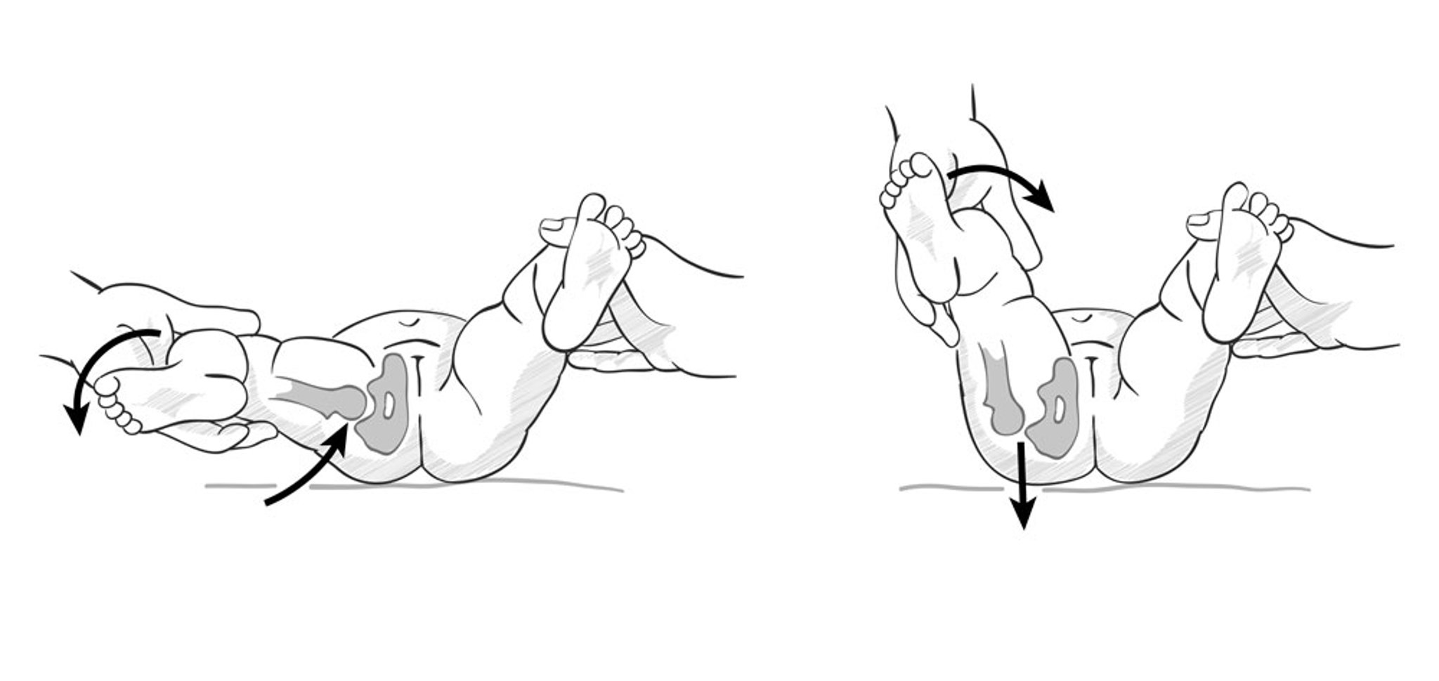 Pruebas para la displasia del desarrollo de la cadera