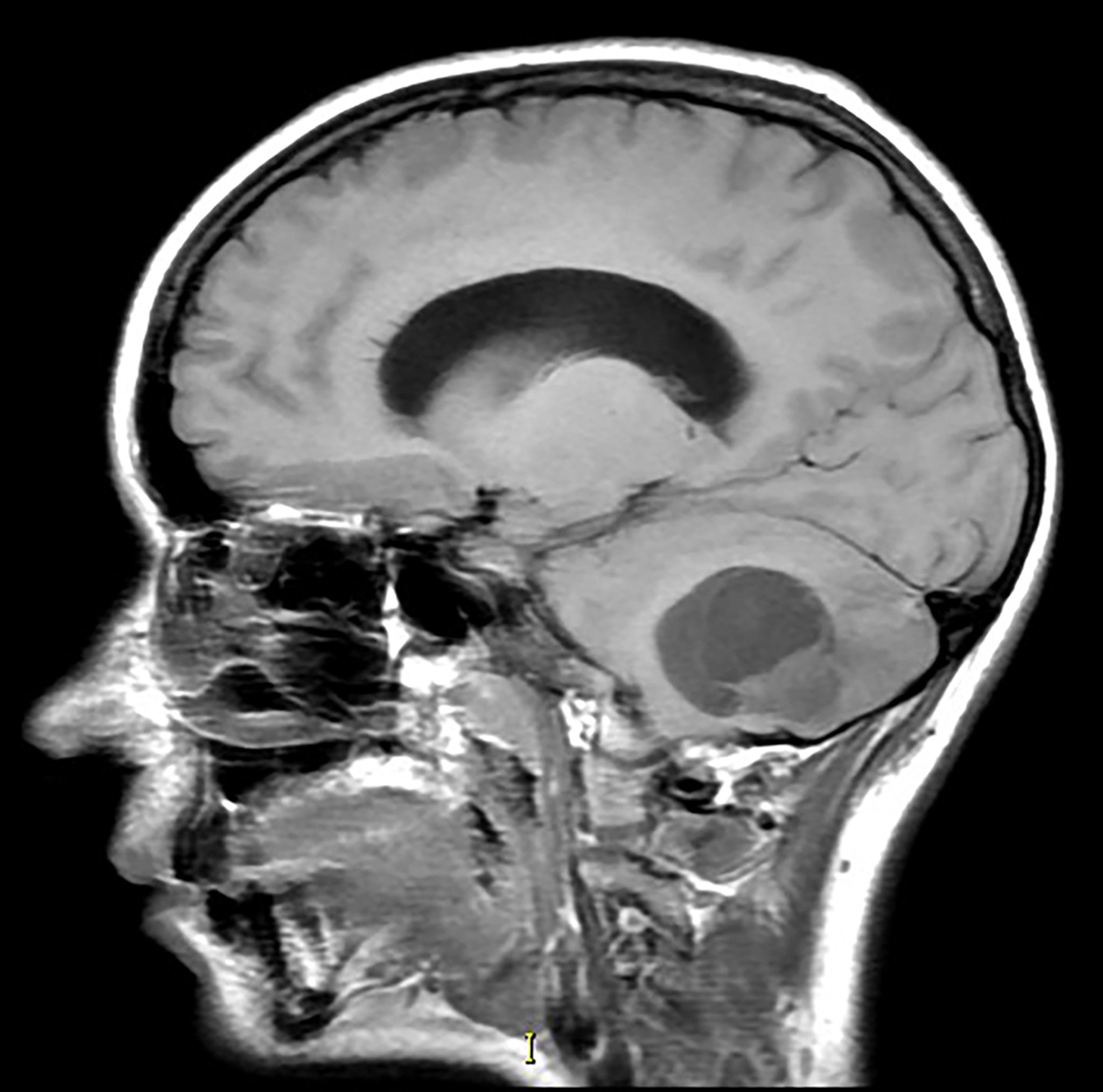 U nguyên bào mạch máu tiểu não (MRI)