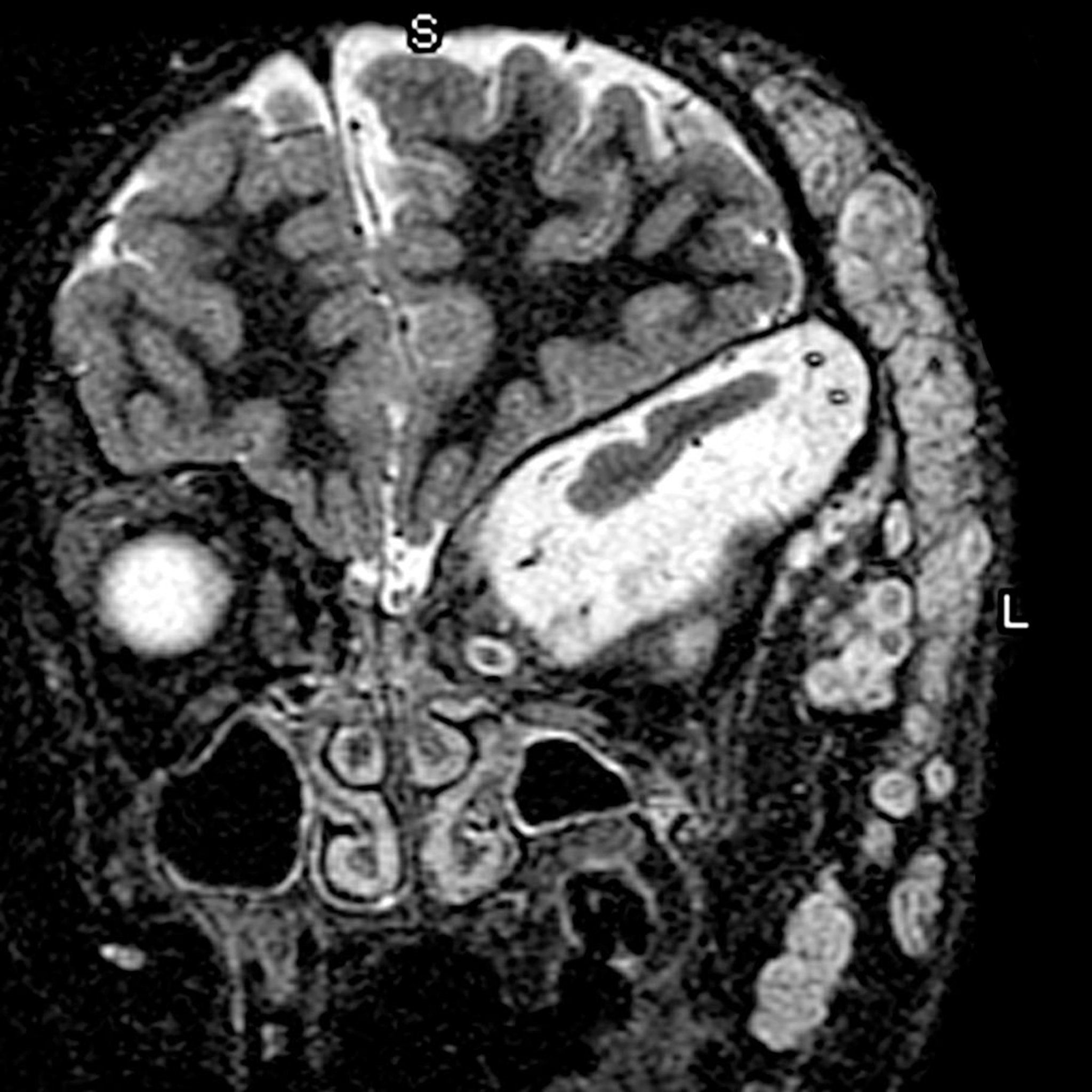 Sphenoid Wing Dysplasia (MRI)
