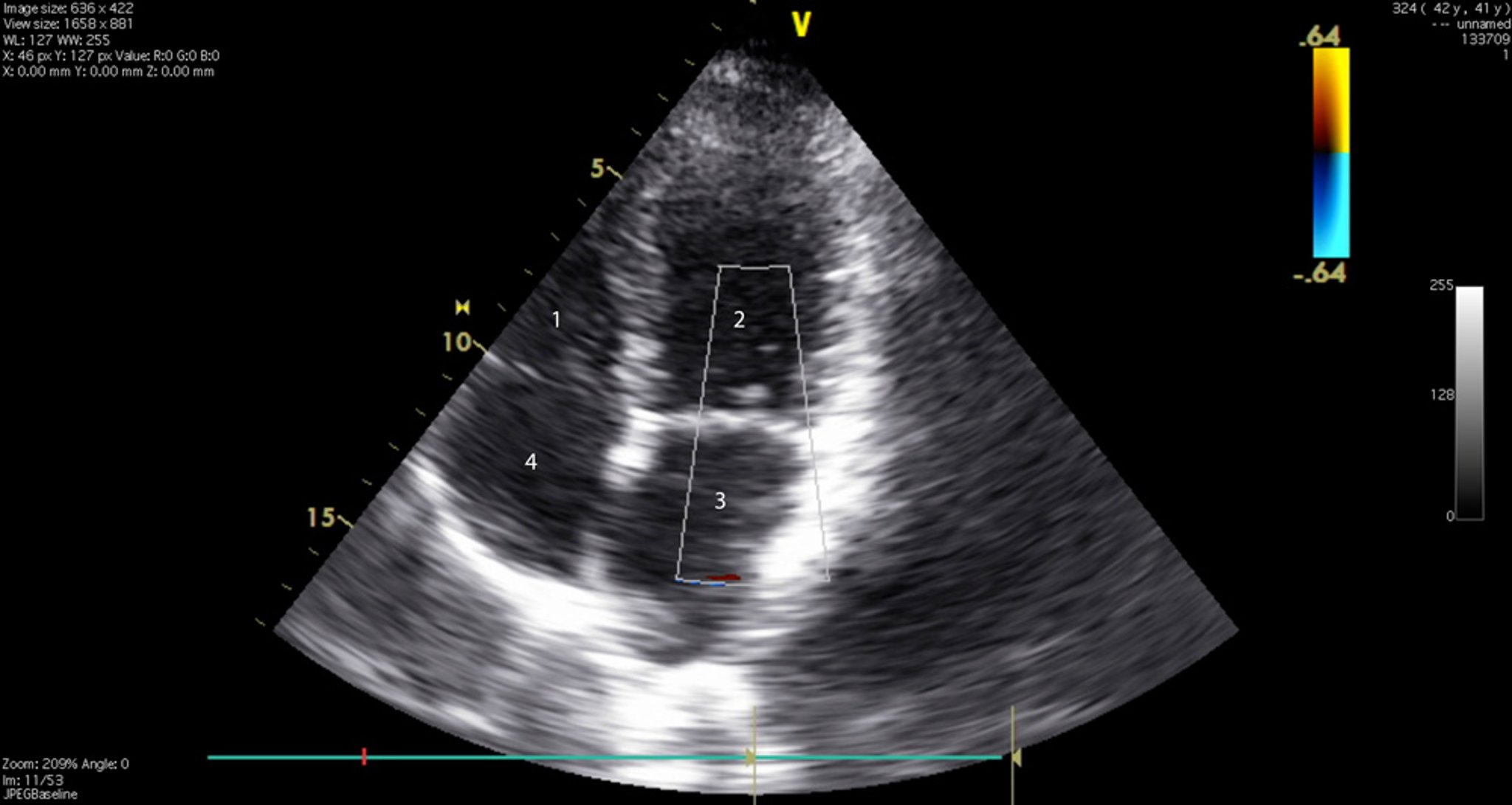 Échocardiogramme (vue des 4 cavités)