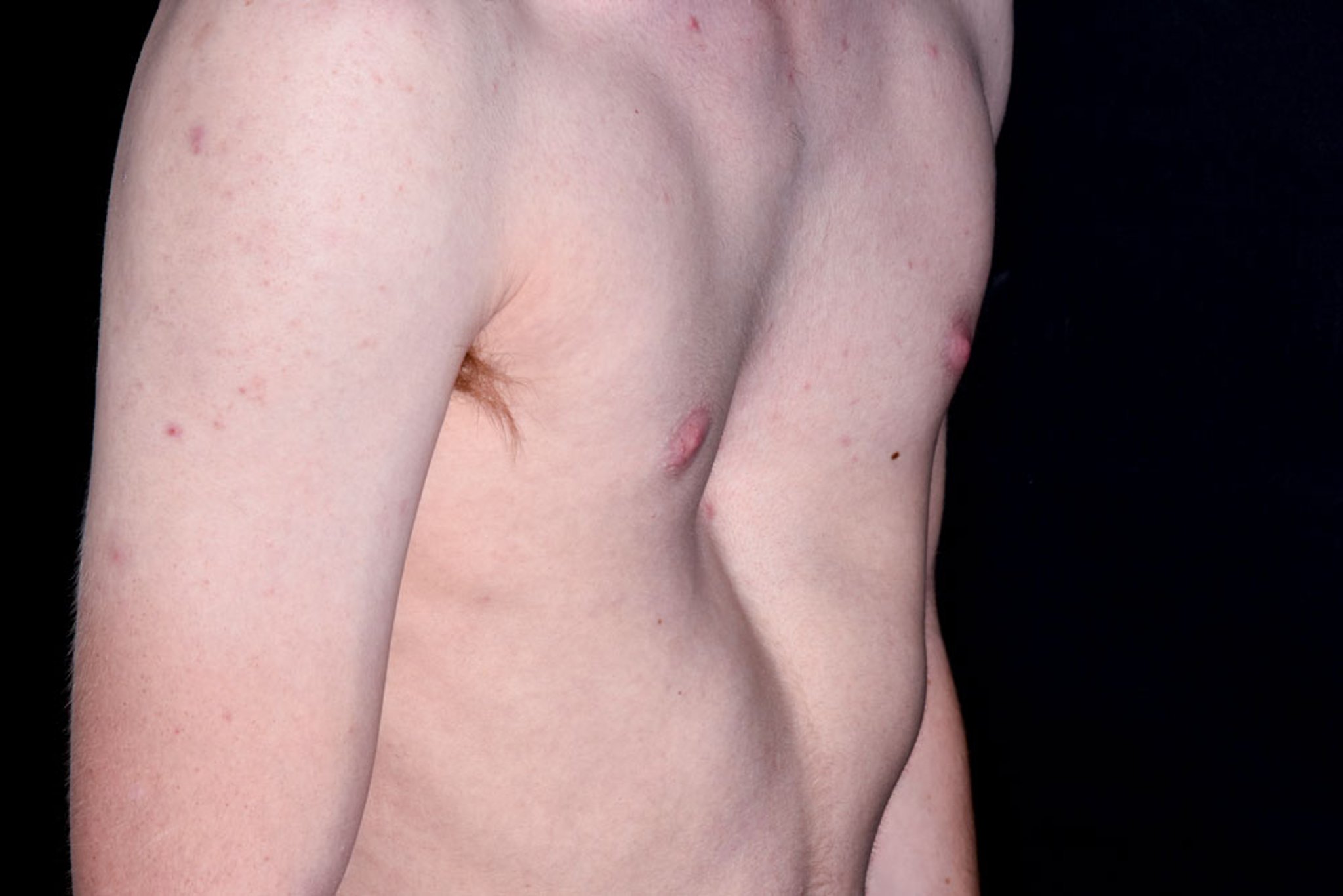 Pectus excavatum