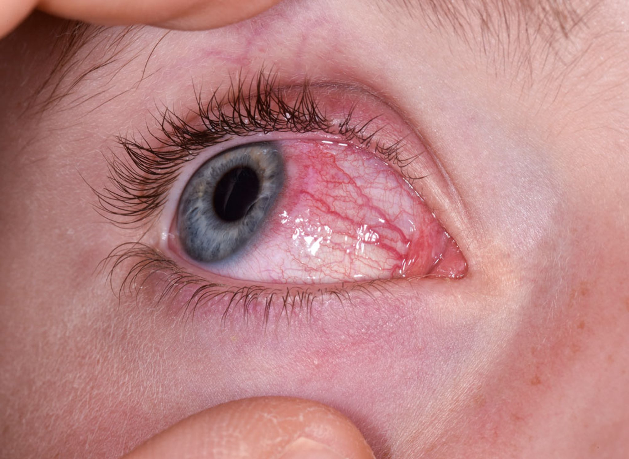 Phlyctenular Keratoconjunctivitis