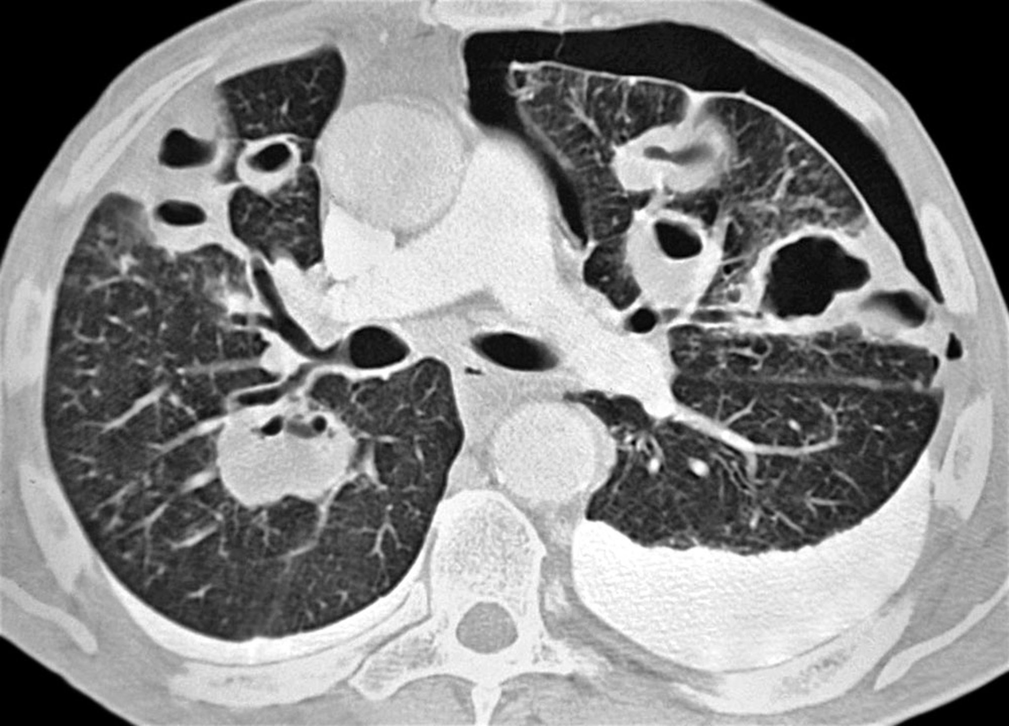 Pneumothorax (CT Scan)