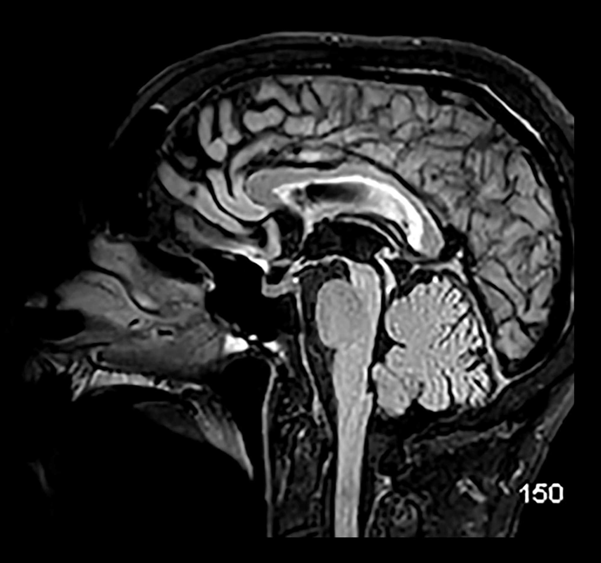 Liệt trên nhân tiến triển (MRI)