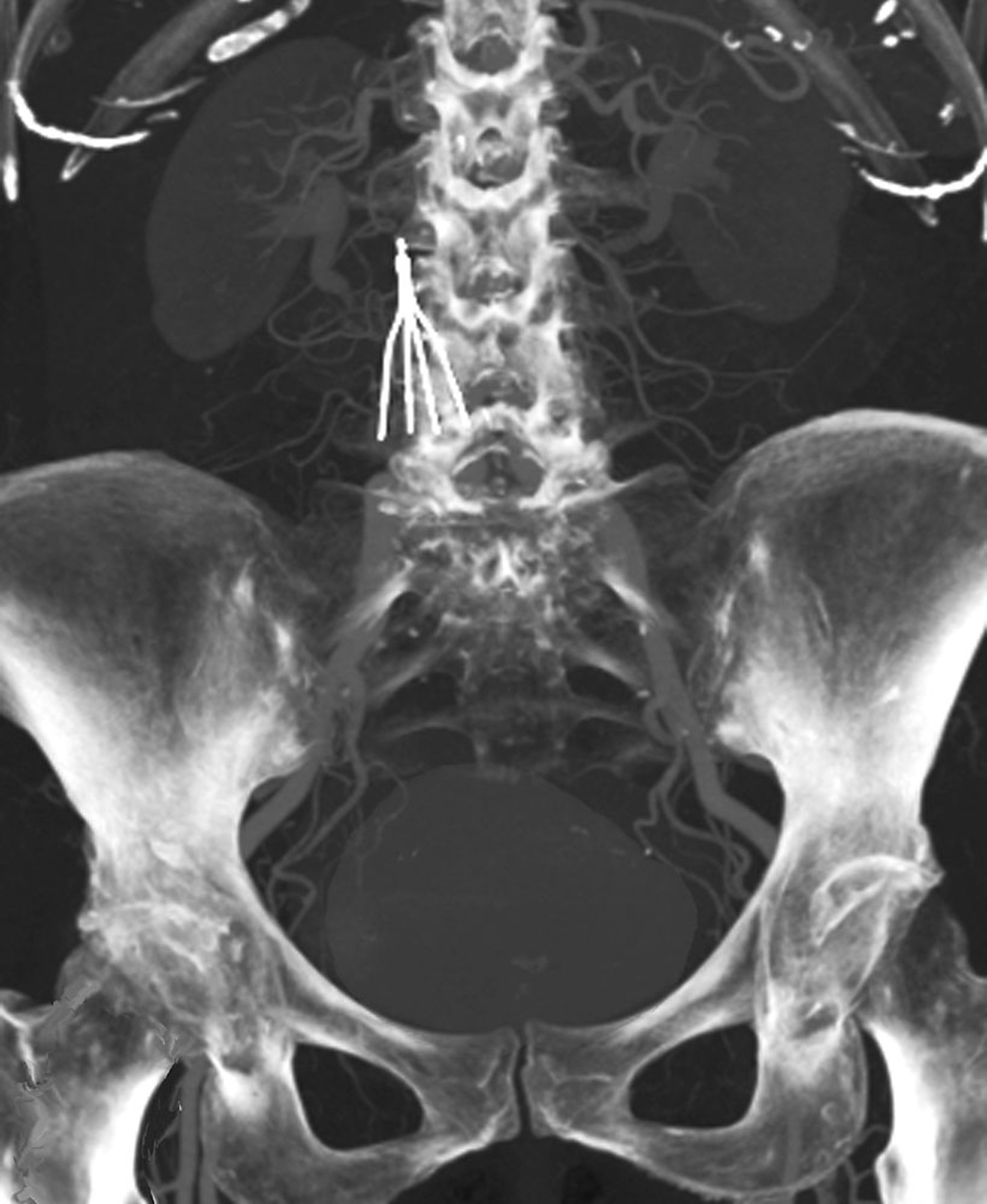 下腔静脉（IVC）滤器