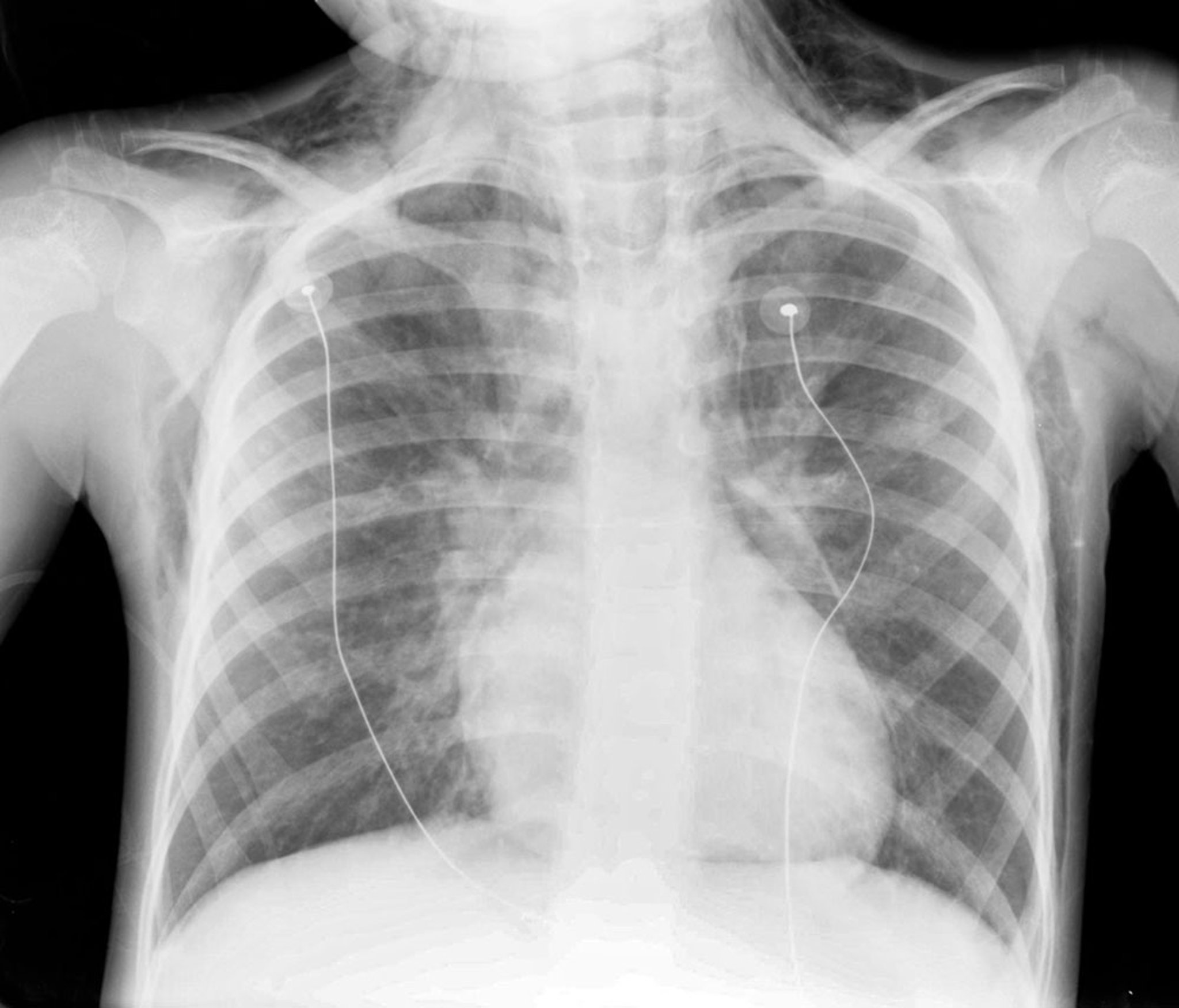 Neumomediastino (radiografía)