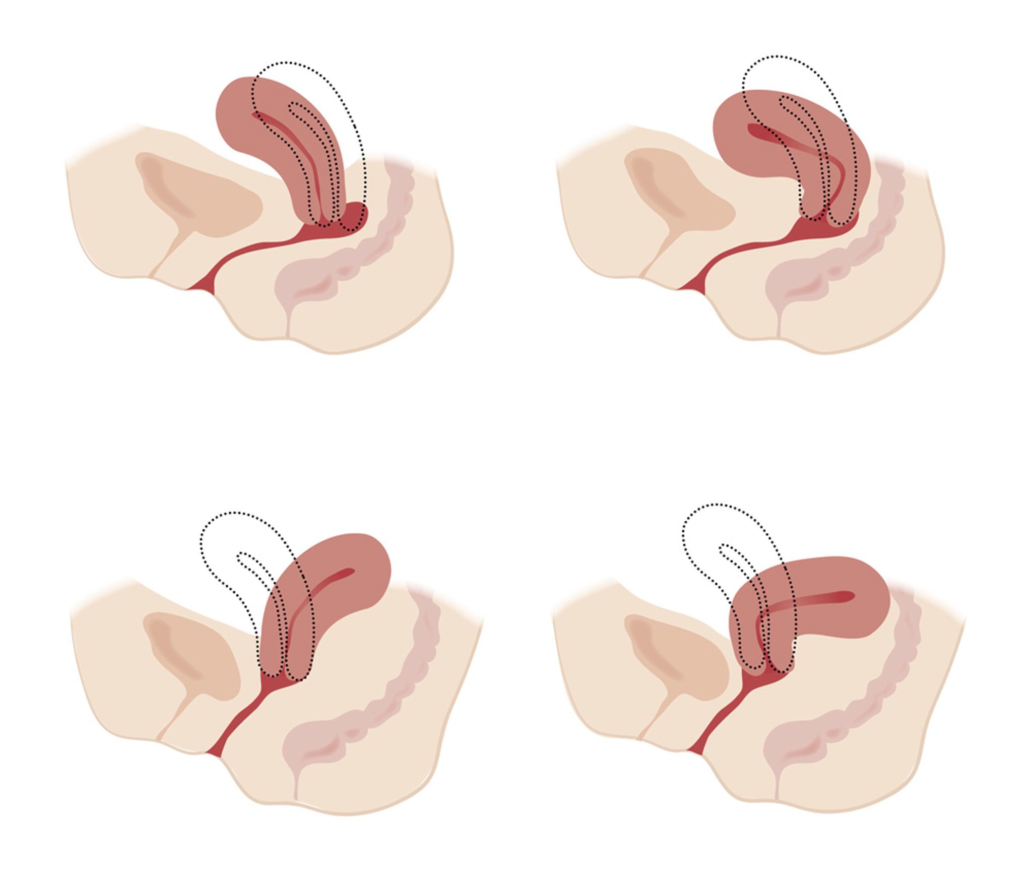 Variations anatomiques de l'utérus