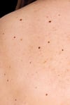 Dysplastic Nevi (Atypical Moles)